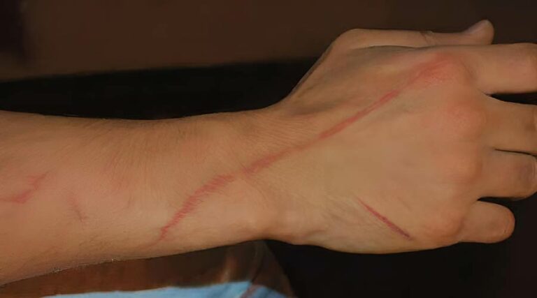 К чему снятся исцарапанные руки — полное толкование сна